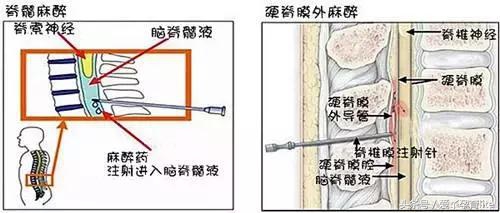 孕妇无痛分娩的故事,无痛分娩快乐孕育