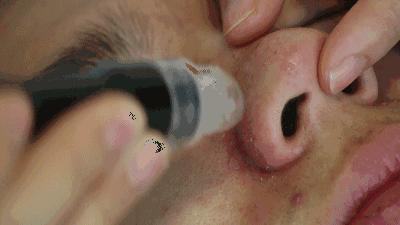 去黑头收缩毛孔的正确方法实测,严重黑头毛孔粗大怎么去除最有效