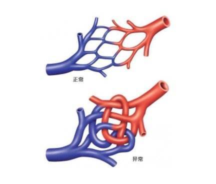 简述颅内动静脉畸形的临床表现,颅内动静脉血管畸形指南