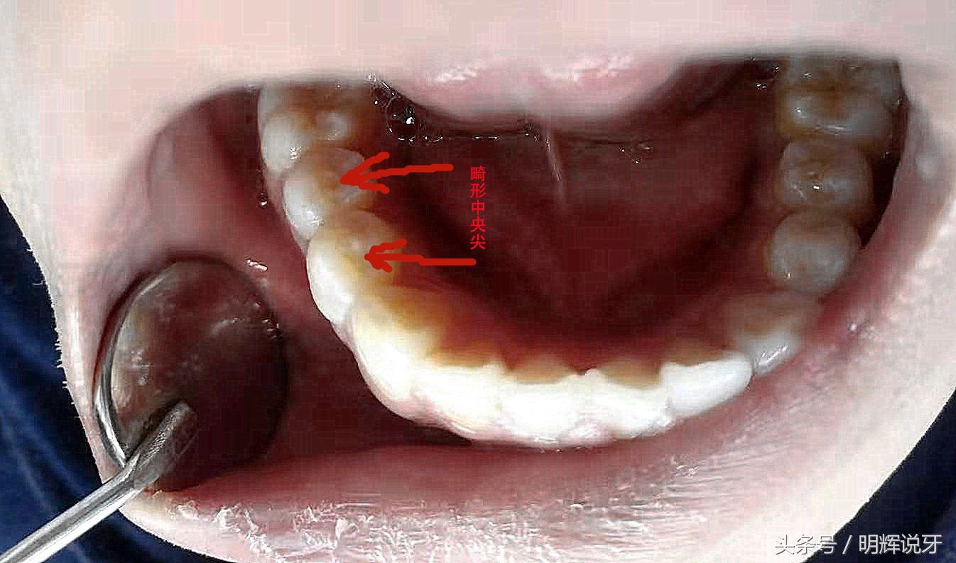 儿童尖牙可以怎么治疗,儿童牙尖炎的症状怎样治疗