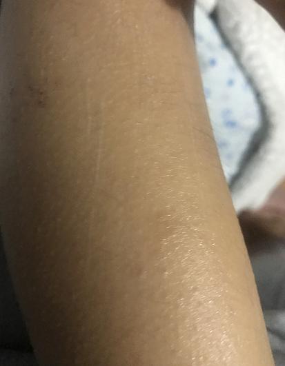 婴儿湿疹脱屑干痒怎么办,宝宝皮肤干燥湿疹擦什么