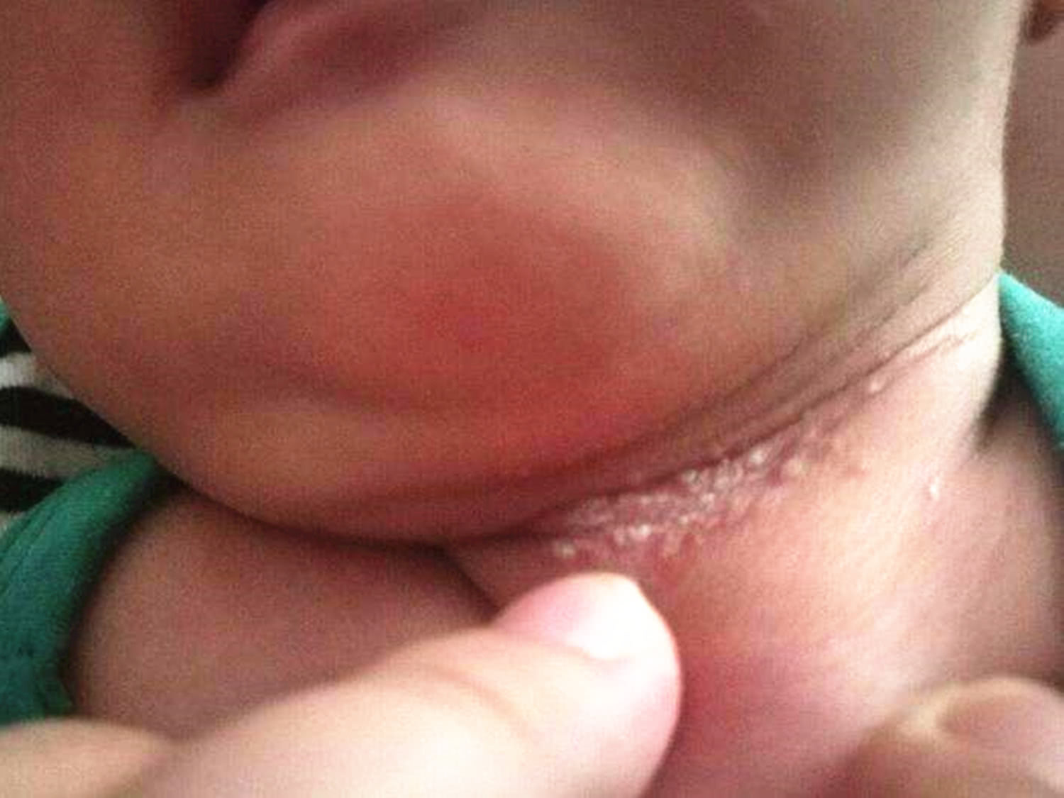 宝宝脖子淹很红了怎么快速恢复,宝宝脖子淹红了怎么快速恢复