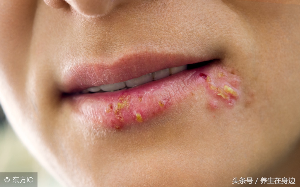 嘴唇干裂怎么办最快最有效方法,嘴唇严重干裂怎么办