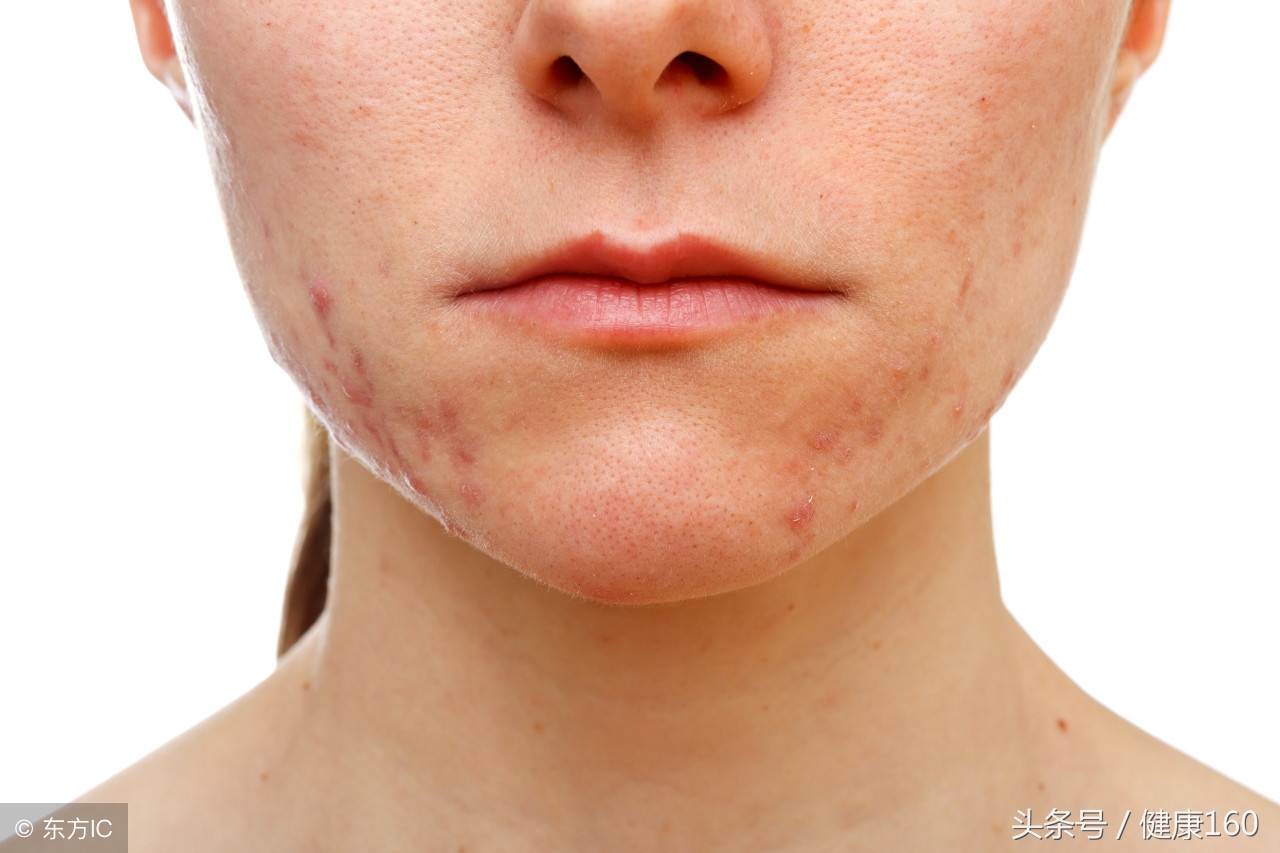 如何识别药店里的药膏是激素药膏？不要再被推销员坑了