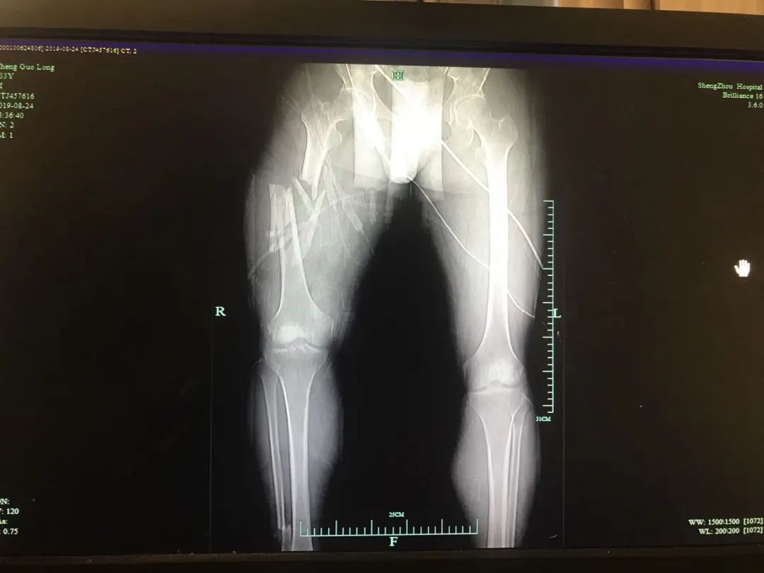 辽宁锦州患者跨数千公里到浙江嵊州只做简单手术背后有个故事