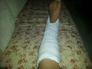 踝关节扭伤包扎,踝关节扭伤热敷