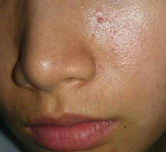 毛孔粗大收缩毛孔最有效的土法,教大家几招改善毛孔粗大的小技巧