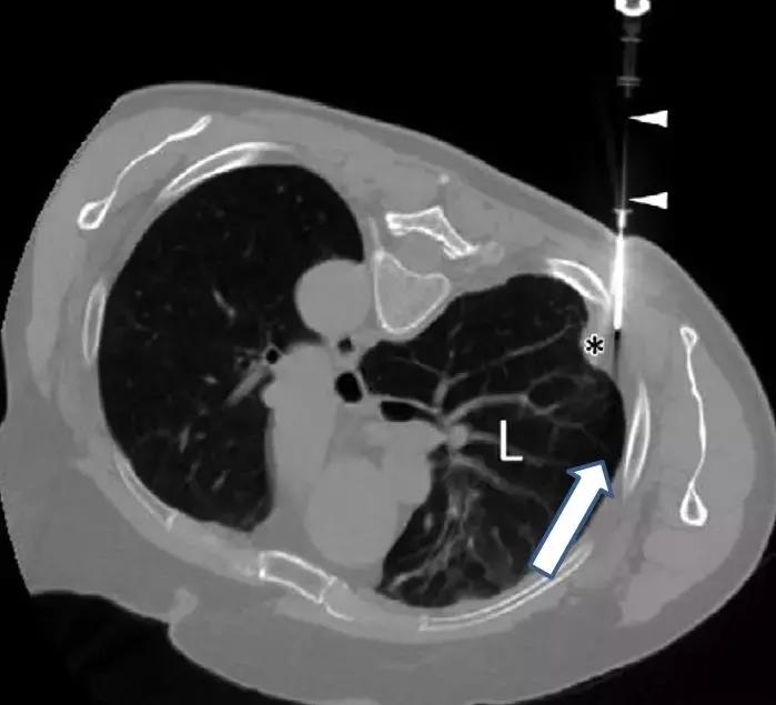 ct引导下穿刺活检诊断的分析,超声引导下穿刺活检什么样子的呢