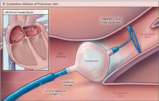 一文盘点：治疗室速的8种方法