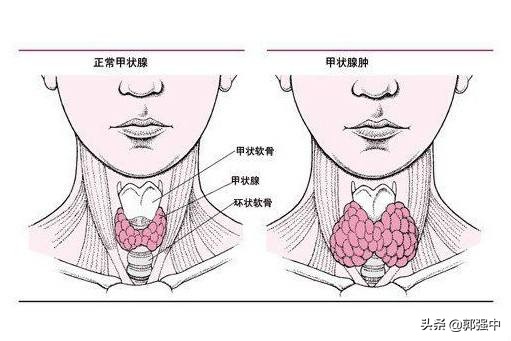中医治疗甲状腺弥漫性肿大甲减,治疗甲状腺肿大