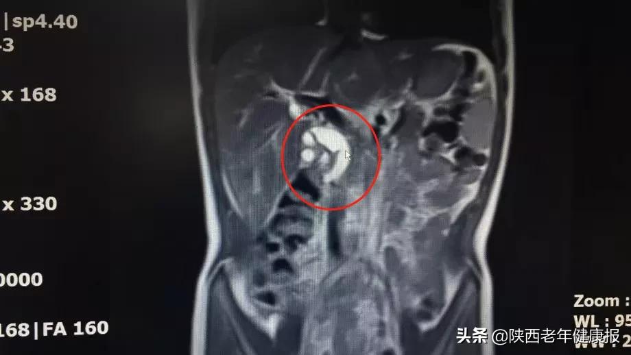 如何区分胃疼和胰腺疾病,半夜经常胃痛跟胰腺有关吗