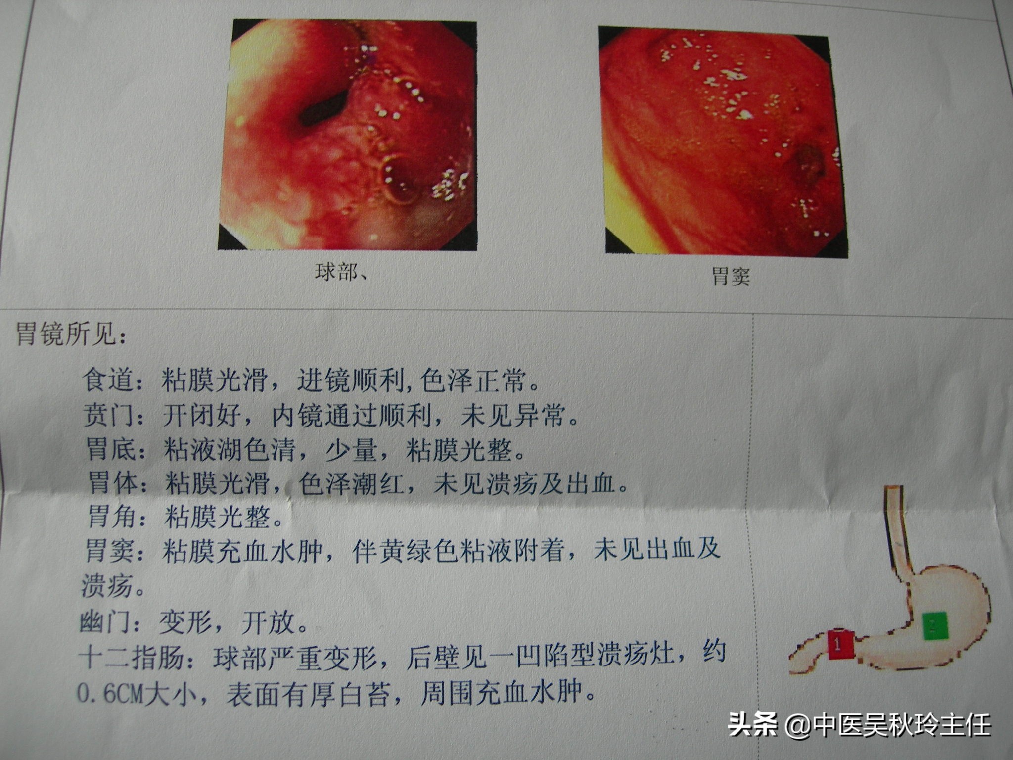 谭先生患十二指肠球部溃疡，反复发作！经中医调理后，不再复发