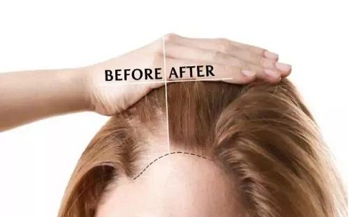 毛囊萎缩的症状有哪些,毛囊萎缩和休止期有什么区别