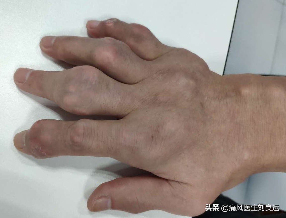 痛风能否真正根治,痛风病可以彻底治疗好吗