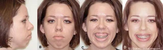 笑露牙龈怎么整,笑露牙龈怎么矫正训练