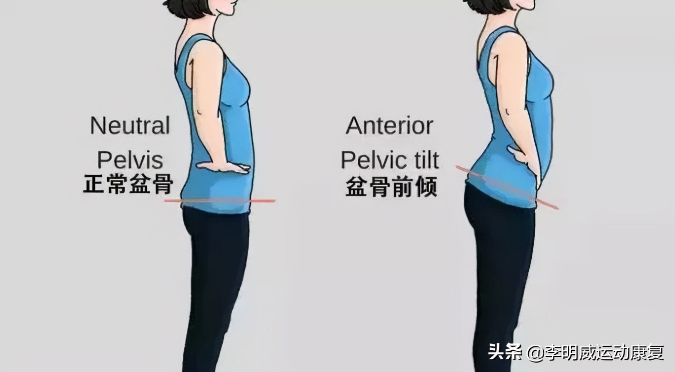 骨盆前倾骨盆不正怎么恢复,骨盆不正会造成什么后果