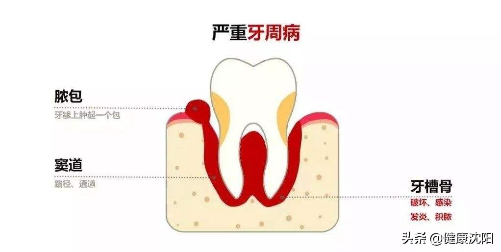 牙龈起包在家怎么办,牙龈有个脓包会传染吗