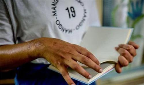 印度女孩因车祸失去双臂，谁知移植黑人手臂后，皮肤竟开始变黑