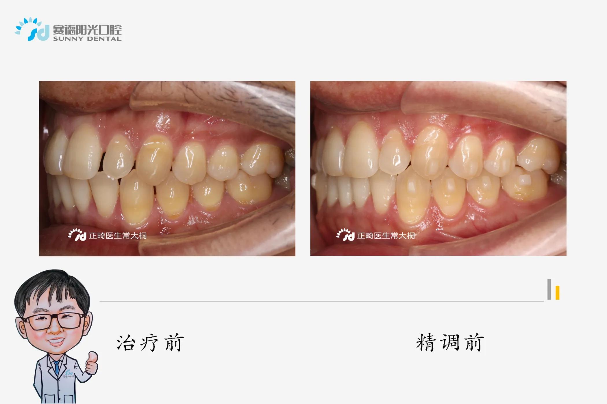 隐适美正畸牙拔掉不美观怎么办,隐适美黑三角什么时候会出现