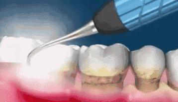 如果不小心得了牙周炎该怎么办,如果牙周炎不治疗会有什么后果