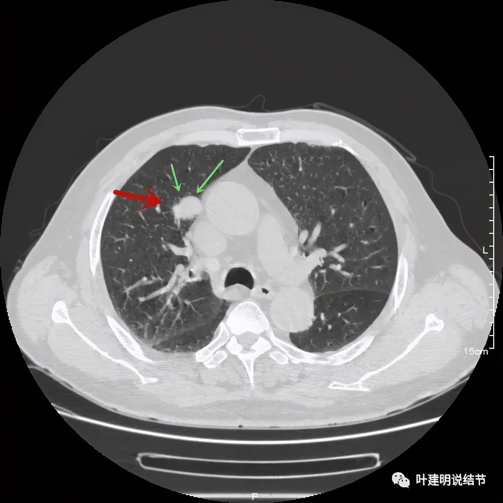 误诊报告图片,误诊案例及案例分析