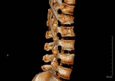 胸腰椎压缩性骨折卧床怎么护理,胸腰椎压缩性骨折怎么治
