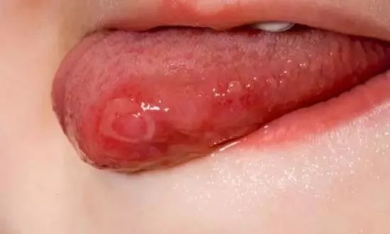 口腔溃疡反反复复体内缺什么,反反复复发作口腔溃疡怎么治疗