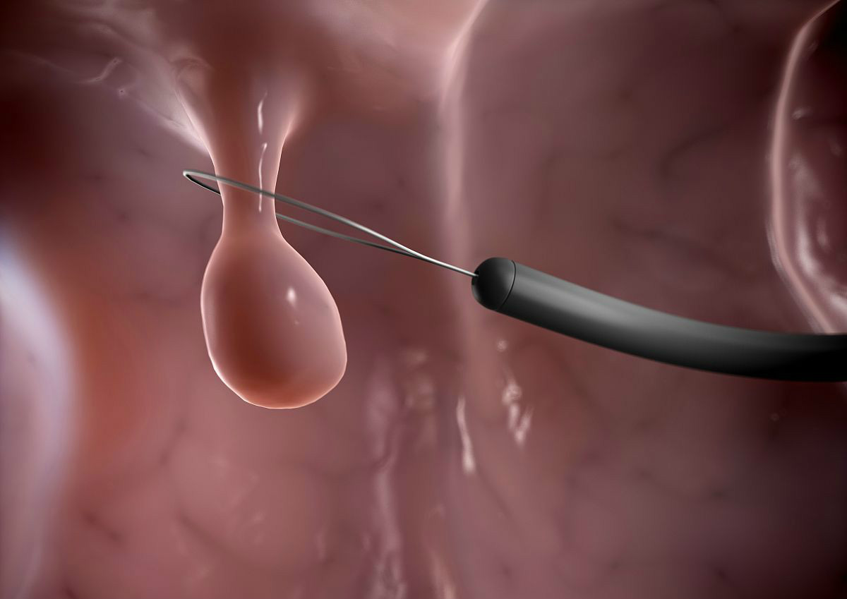 息肉是癌细胞还是痔疮,息肉是肿瘤的一种吗