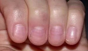 娃指甲上有白点是怎么回事,孩子指甲横纹有白点