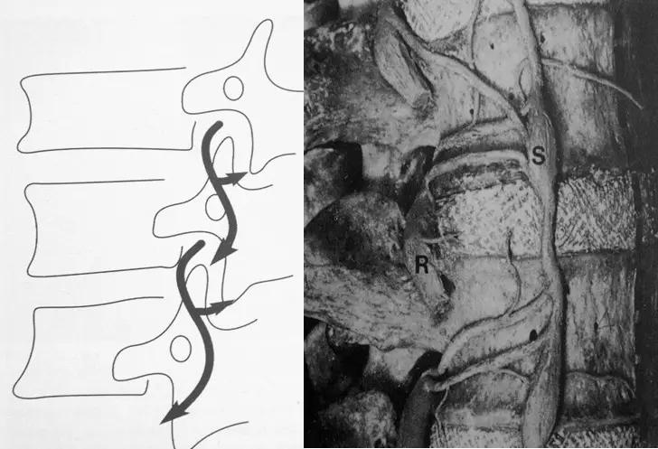 颈椎腰椎疾病ct及mri诊断,腰椎ct可以发现肠部病变吗
