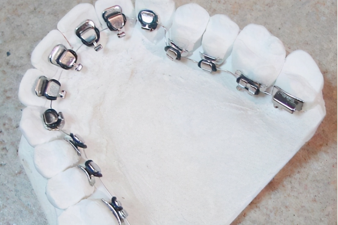 矫正牙齿选择什么托槽好,罗云熙牙齿矫正对比