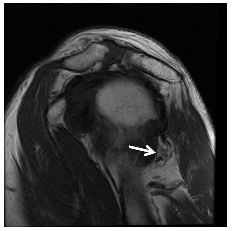 肩贞穴疼痛反应什么问题,肩膀酸困是内脏问题