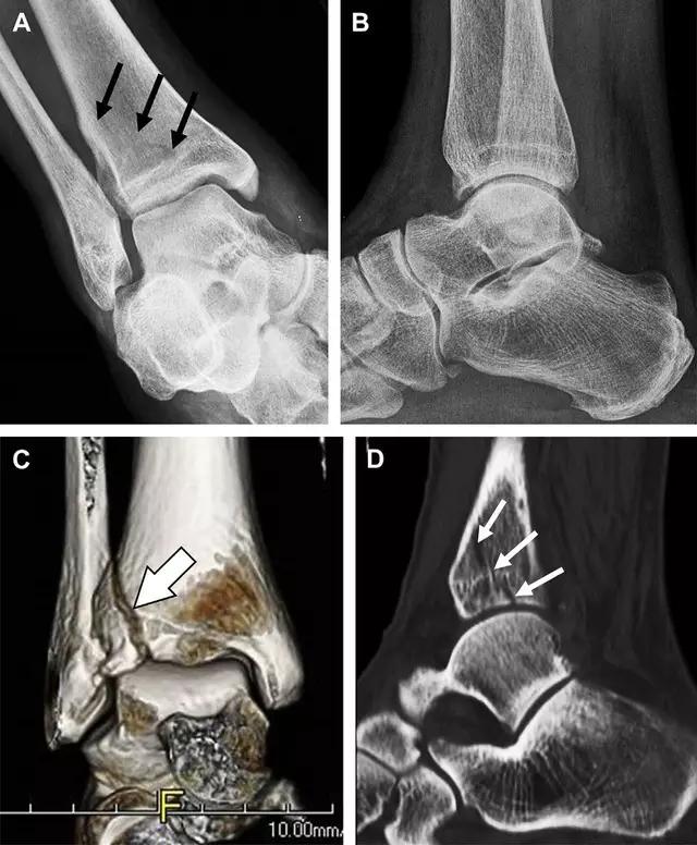 特殊骨折类型,特殊骨折体征