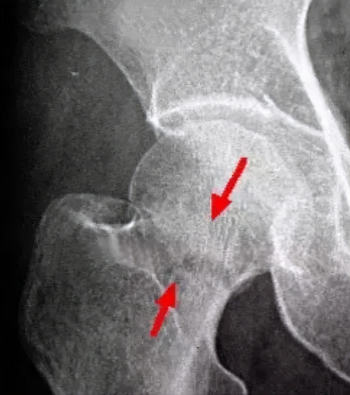 股骨头坏死的克星,股骨头坏死中成药
