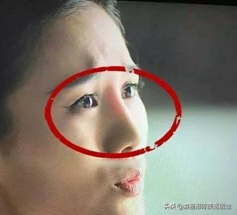 假体隆鼻后鼻子变歪该如何处理,假体隆鼻透光如何处理