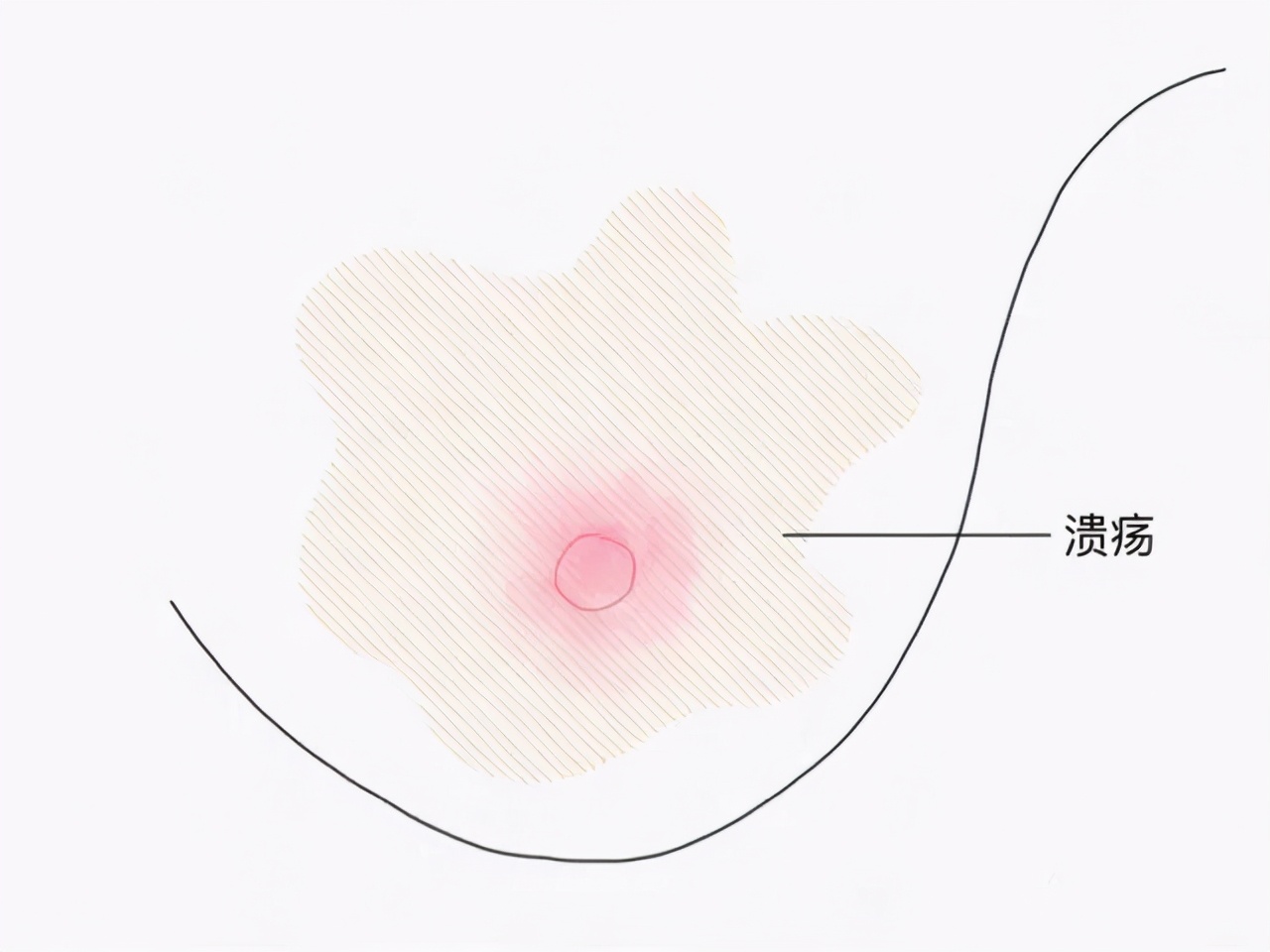 哺乳期乳头经常白泡怎么回事,哺乳期白点和白泡区别