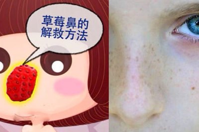 草莓鼻和非草莓鼻有什么区别,草莓鼻怎么消除最干净学生