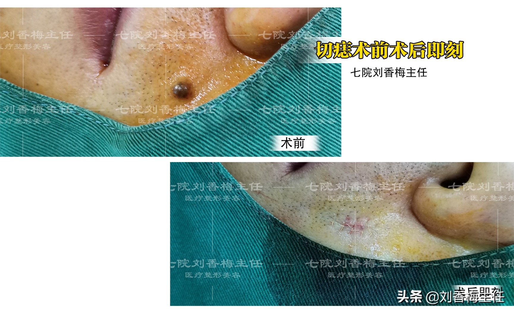 黑痣要不要去除,黑痣切除医生说需要做病理