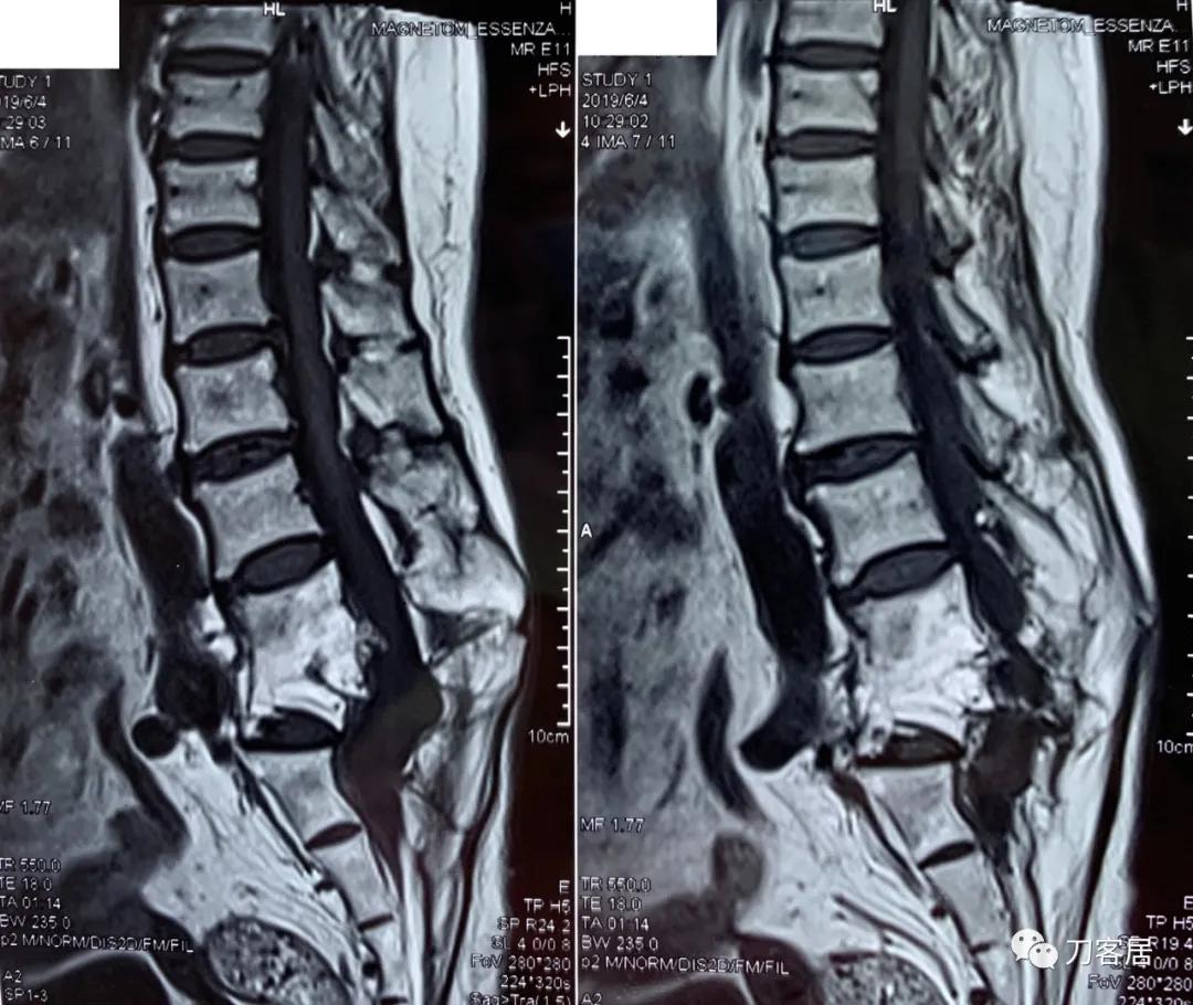 腰椎结核手术没有清病灶,腰椎结核术后不排气