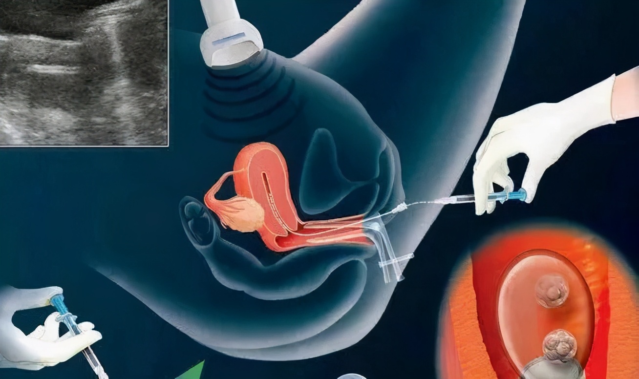 女性取完卵要全身麻醉,取多少卵需要打麻醉