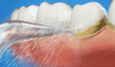 刷牙姿势不对牙龈有缝隙怎么补救,刷牙洗脸处好多苔藓