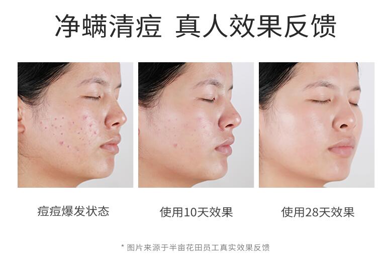清理黑头痘痘的治愈过程,祛痘痘痘印黑头用什么好