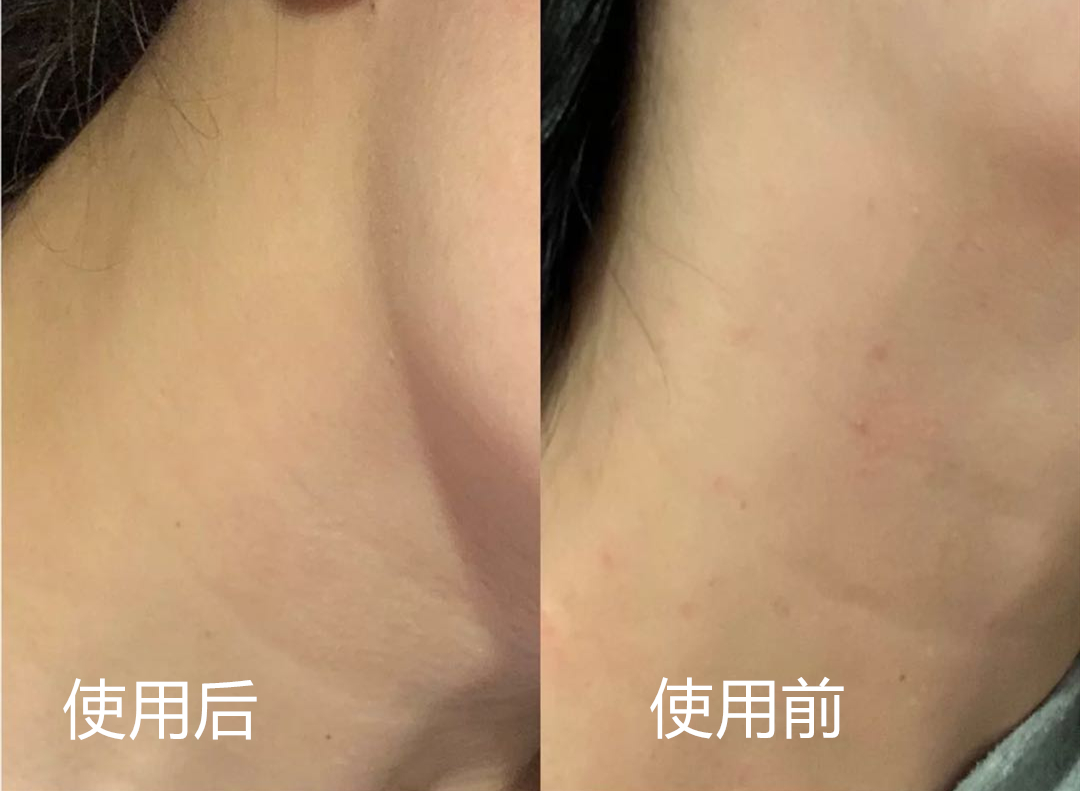 脂肪粒去粒神器 (日本自动消除脂肪粒)