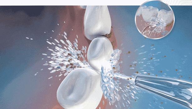 洗完牙吃东西牙齿酸怎么回事,洗完牙后牙齿很酸