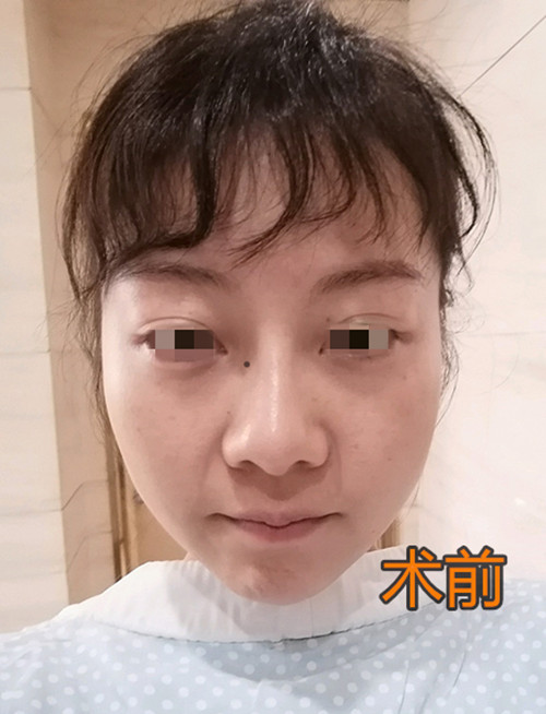 内窥镜拉皮除皱效果,48岁做内窥镜拉皮手术亲身经历