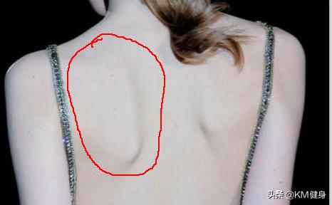 背部肩胛骨凸起该怎么改善图片,后背肩胛骨高低如何矫正