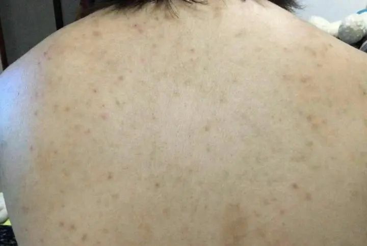美背长痘,后背长痘的美背方法