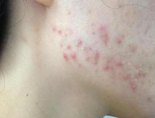 下巴长痘痘祛痘精华,下巴频繁长痘痘的正确消除方法