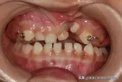 牙齿矫正地包天多久能看到效果,地包天越早矫正越好吗