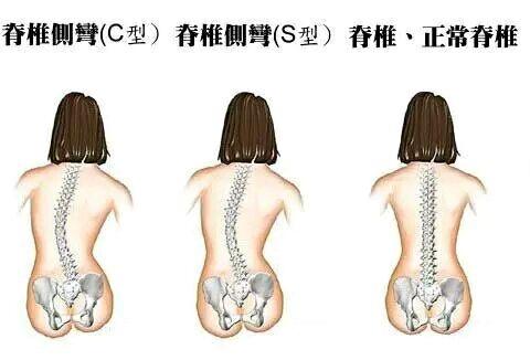 脊柱侧弯矫正视频教程完整,脊柱侧弯中医正骨矫正视频